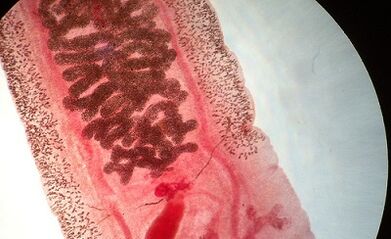 Anquilostomosi nell'uomo