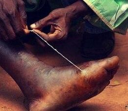 Parassita nel piede di una persona