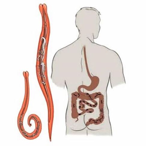 Vermi nell'intestino umano
